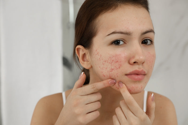 girl with acne in singapore