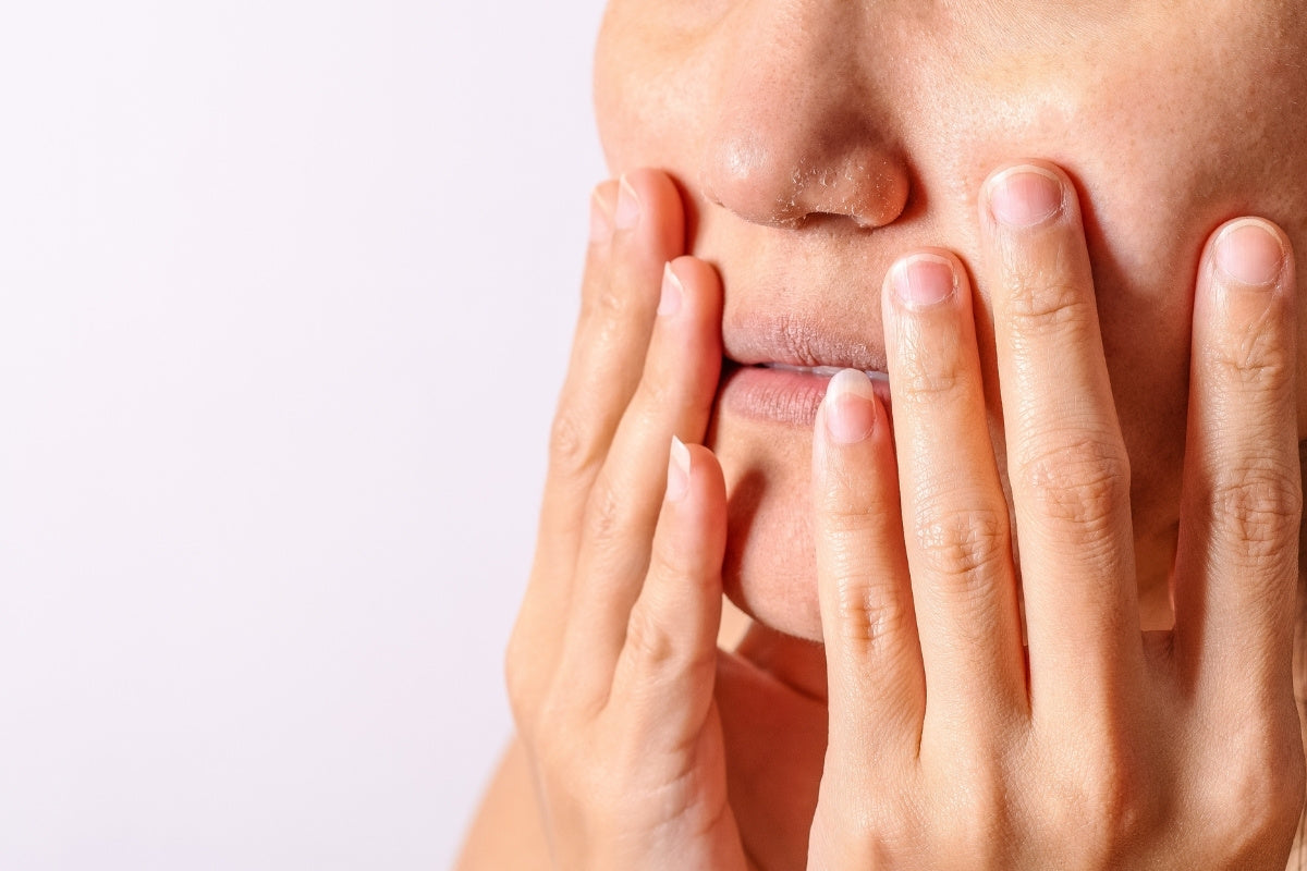 woman with eczema on face